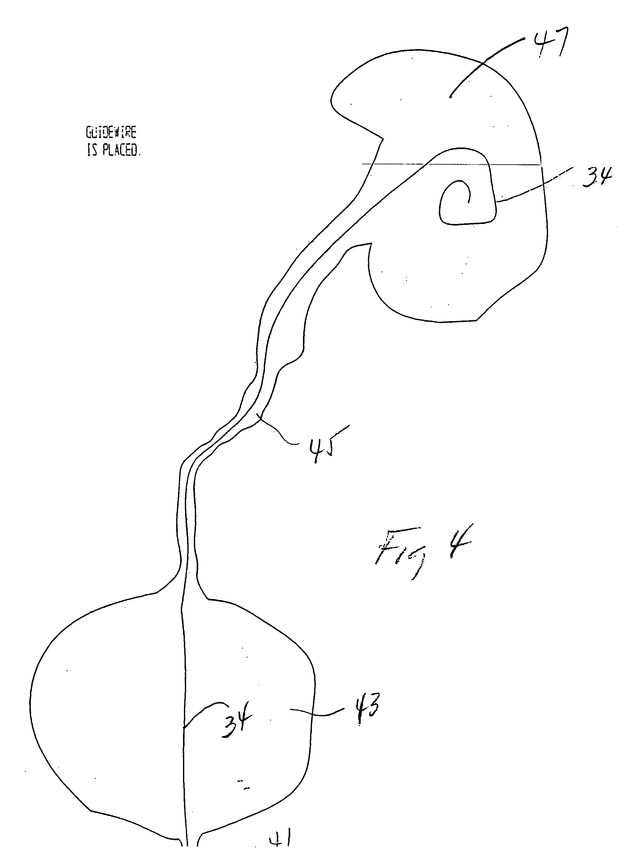 Stent delivery system and method