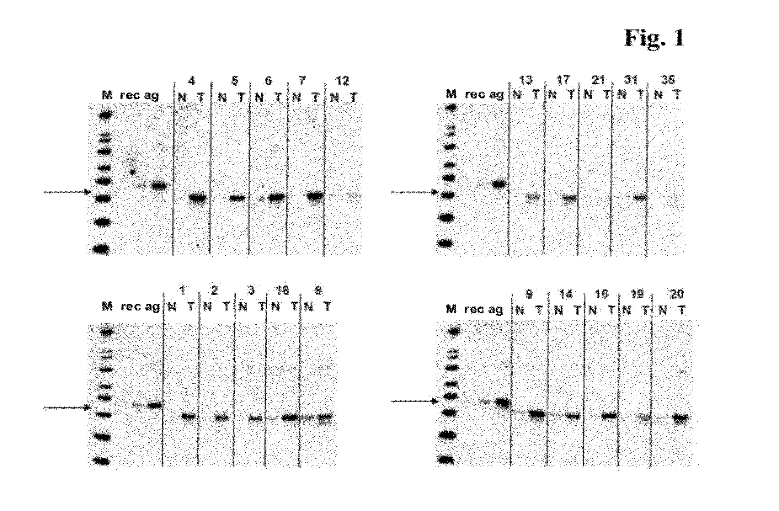 Flap Endonuclease-1 As A Marker For Cancer