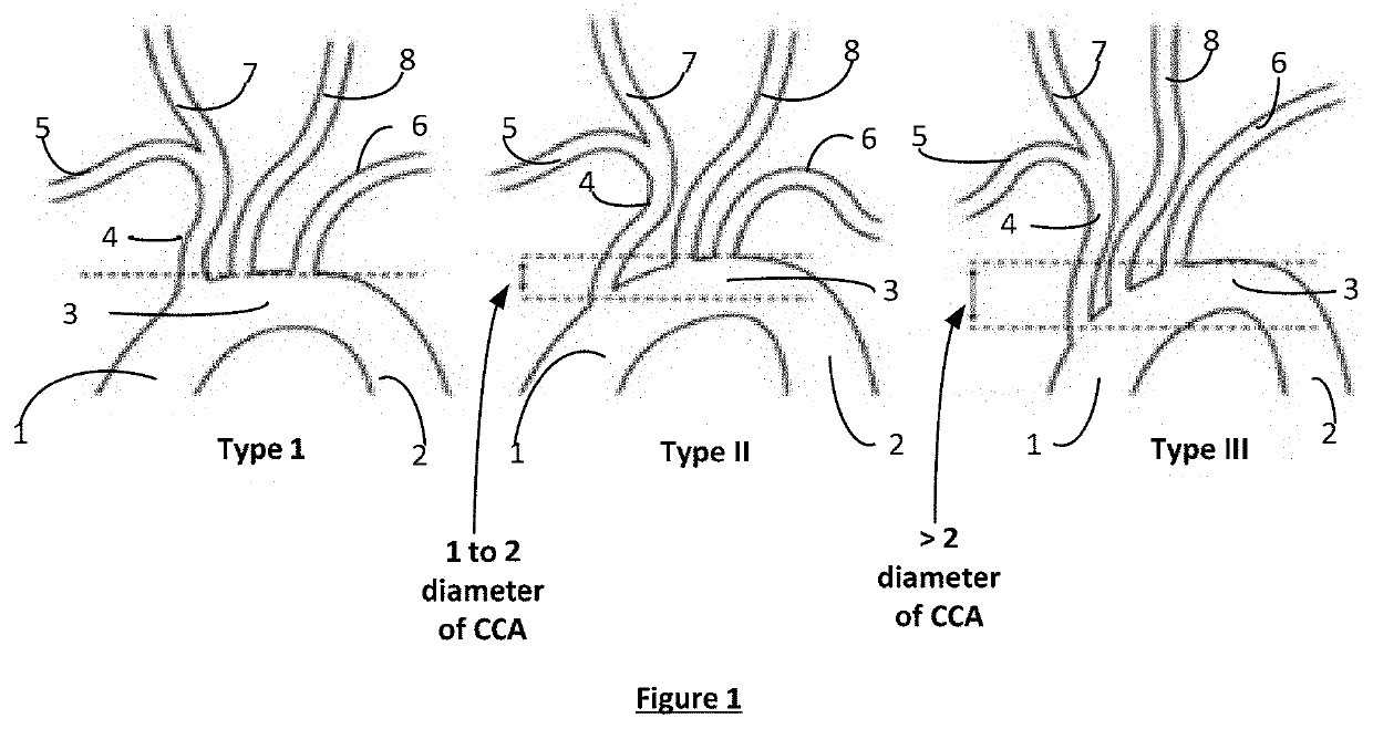 Bifurcated “Y” anchor support for coronary interventions