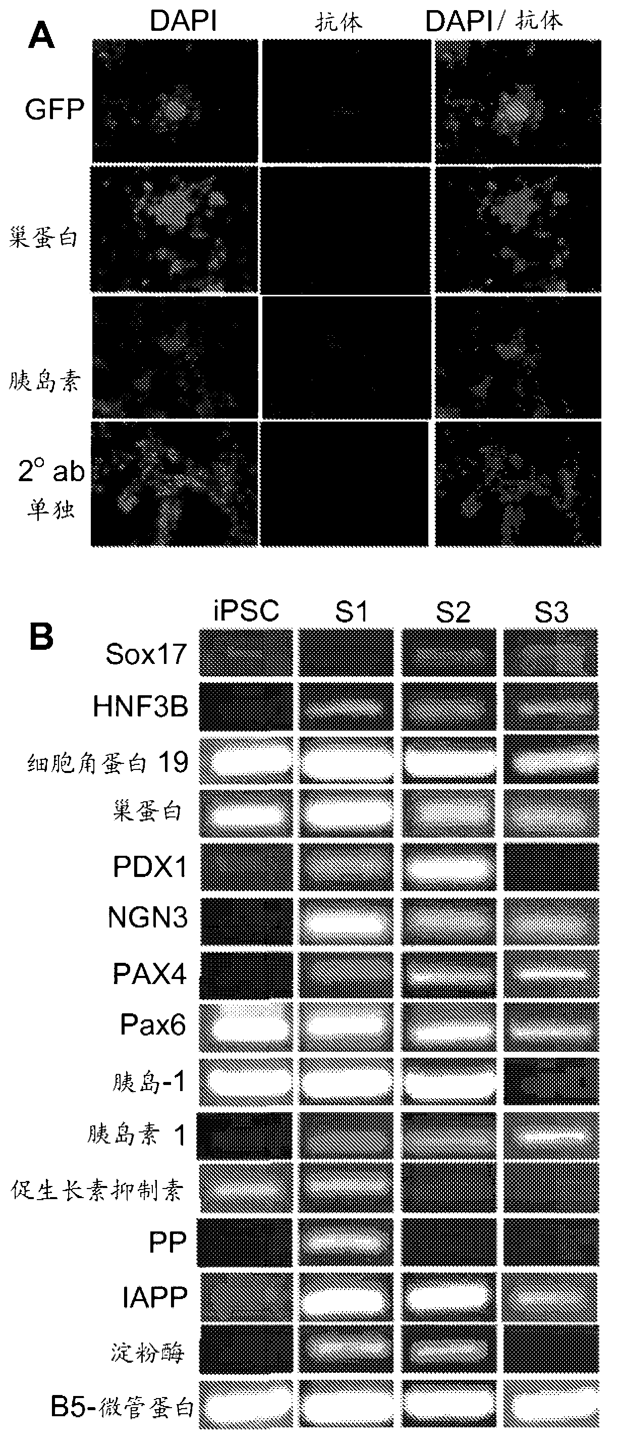 Methods and compositions for treating diabetes with iPS derived pancreatic beta-like cells