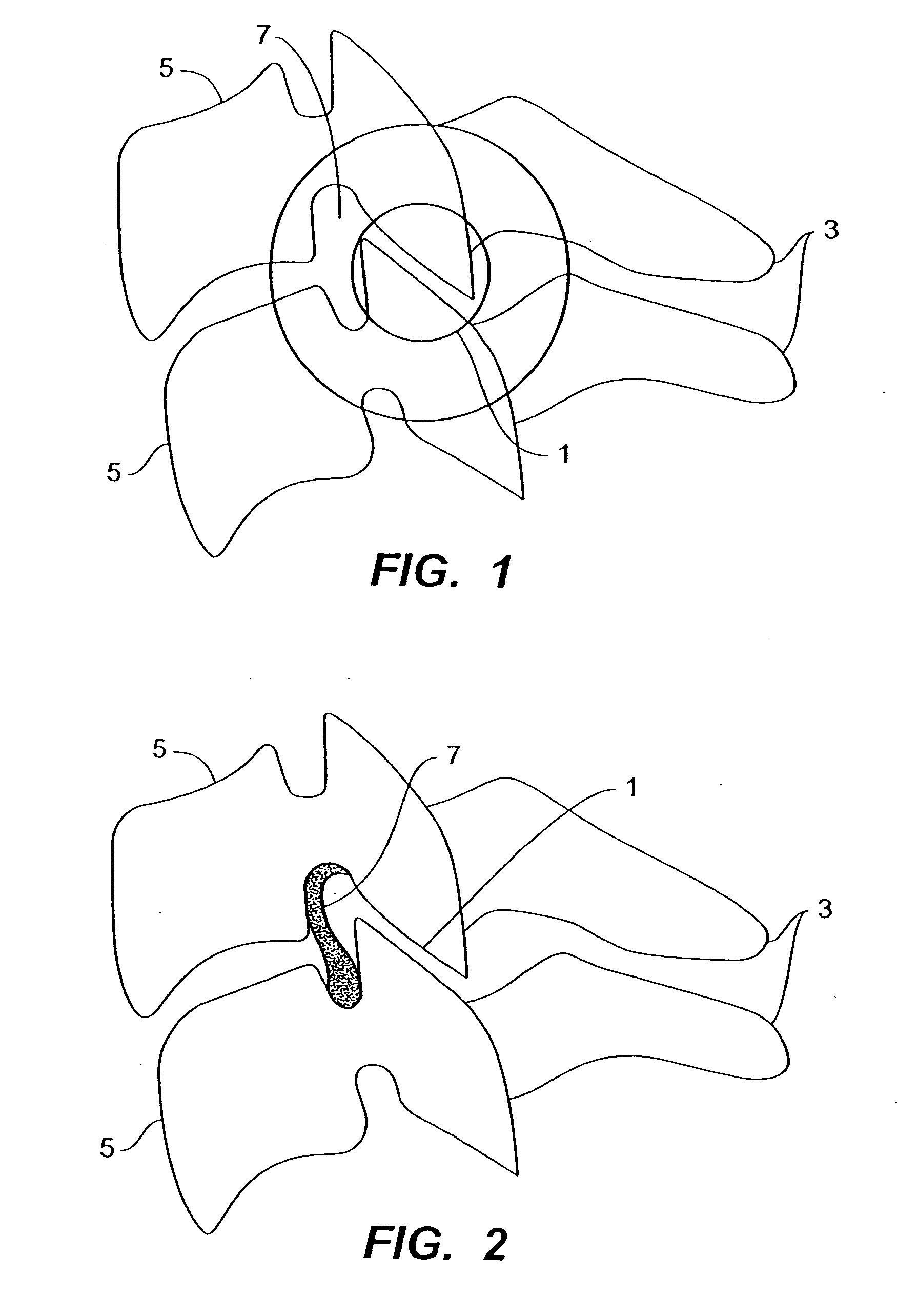 Inter-cervical facet implant with multiple direction articulation joint and method for implanting