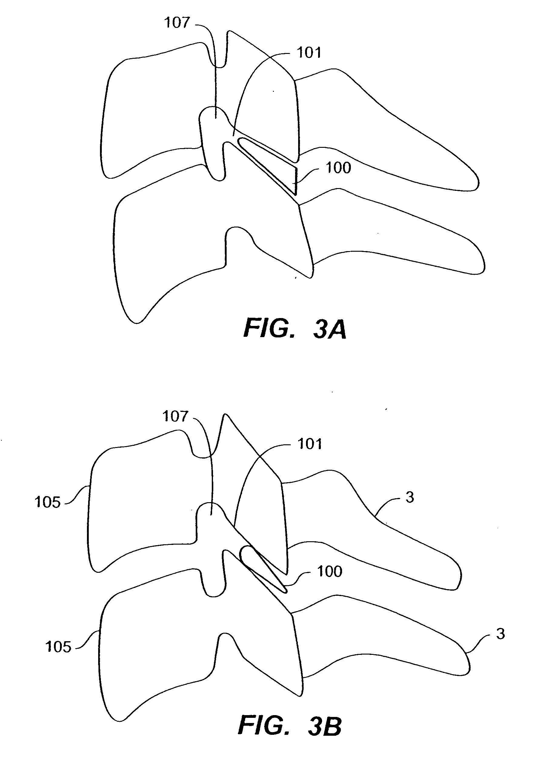 Inter-cervical facet implant with multiple direction articulation joint and method for implanting