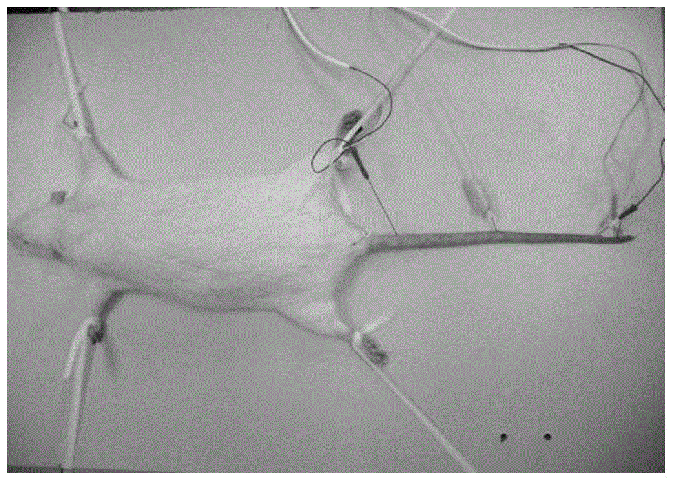 A compound preparation for treating painful diabetic neuropathy and its application