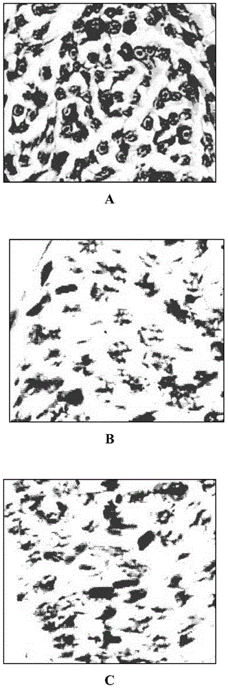 A compound preparation for treating painful diabetic neuropathy and its application