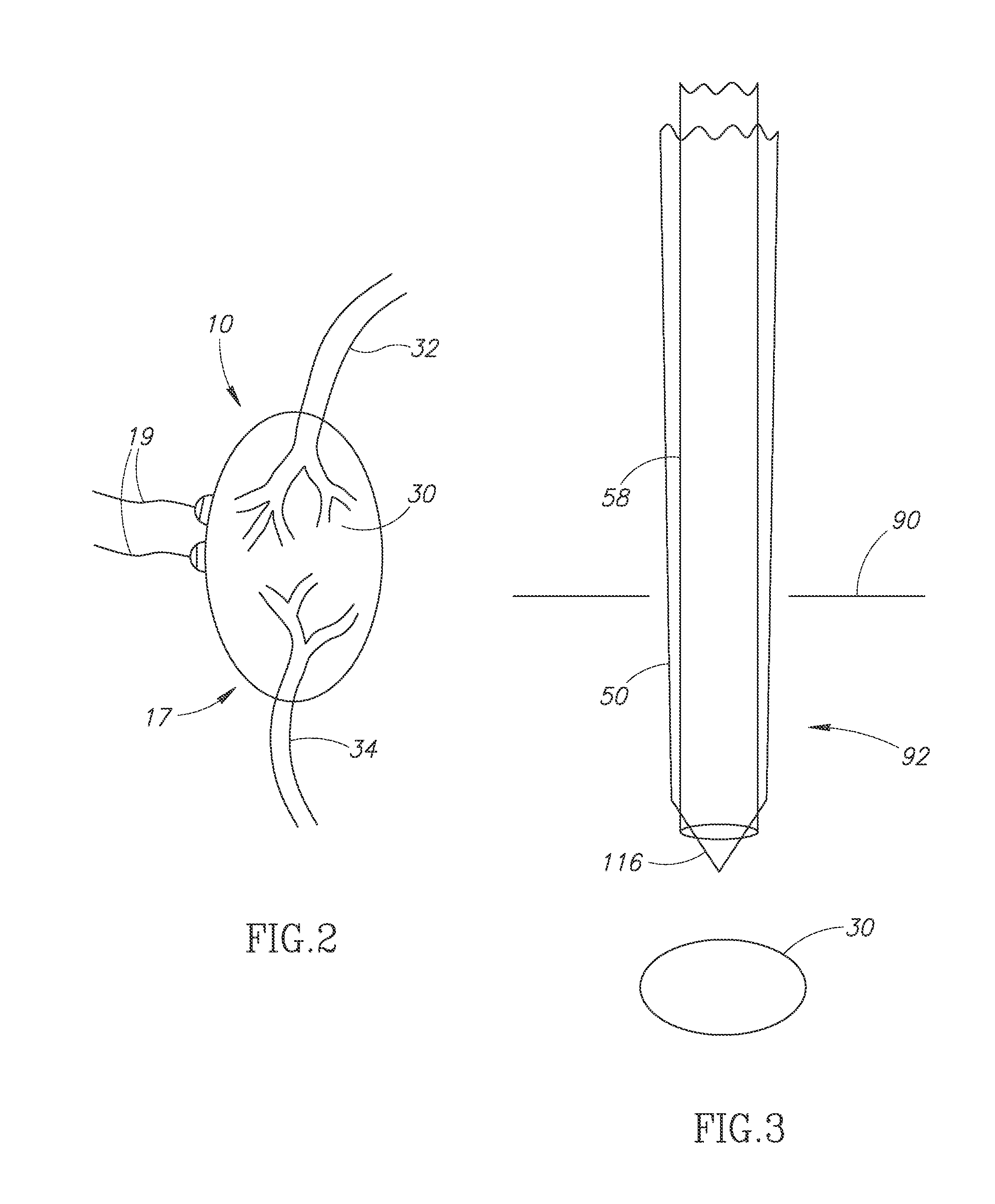 Non-invasive and minimally invasive and tightly targeted minimally invasive therapy methods and devices for parathyroid treatment