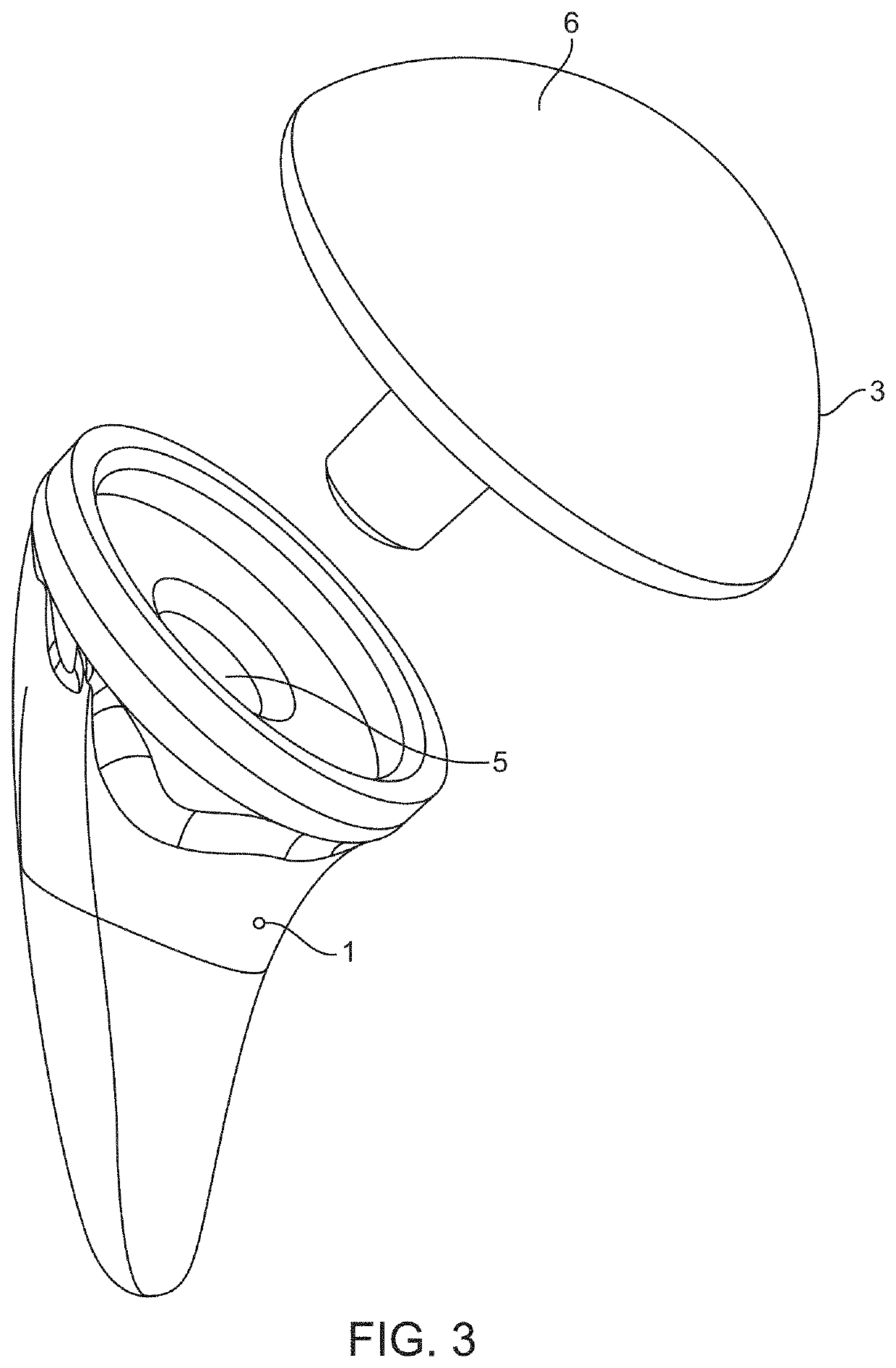 Shoulder arthroplasty implant system