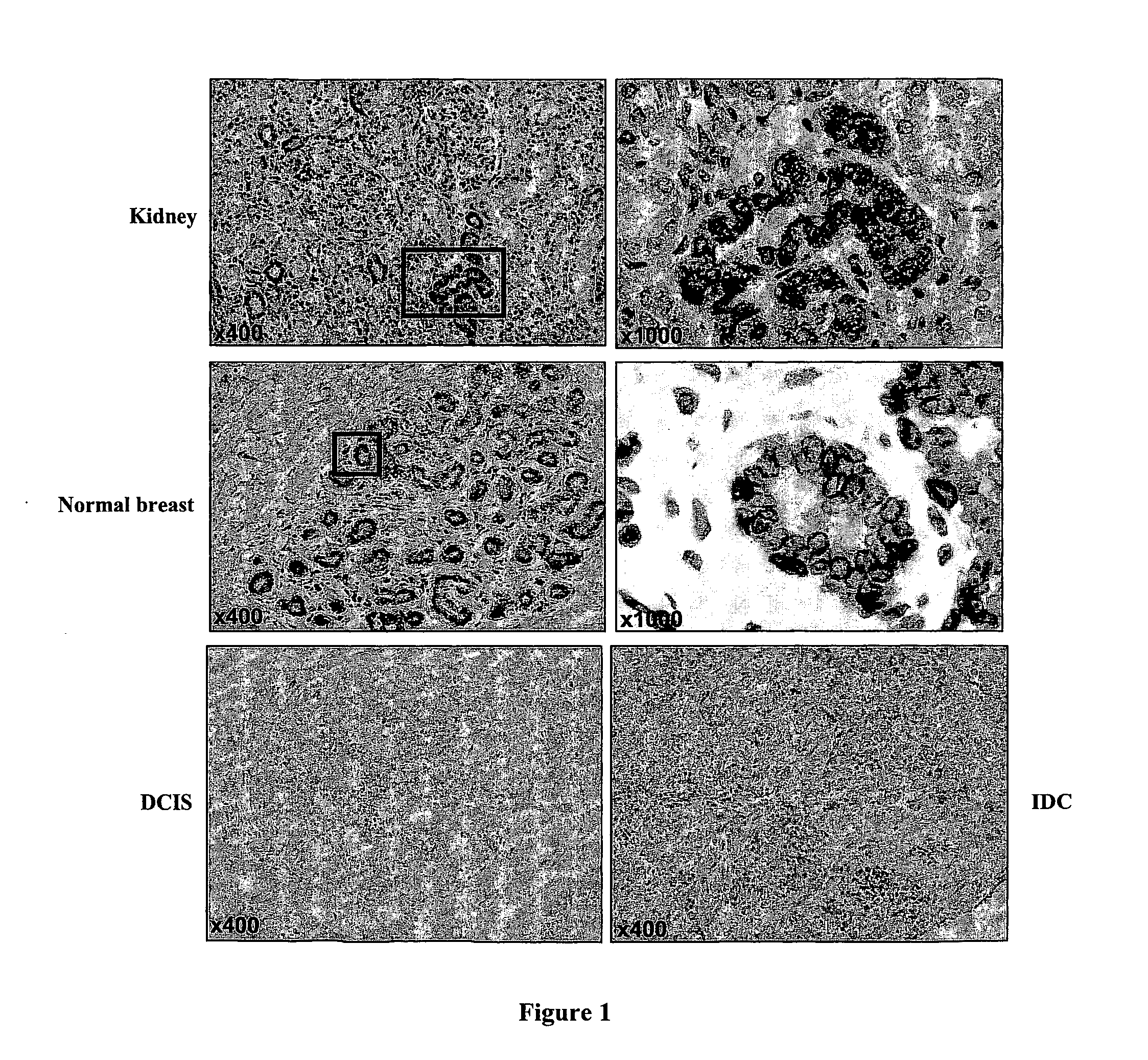 Klotho Protein and Related Compounds for the Treatment and Diagnosis of Cancer