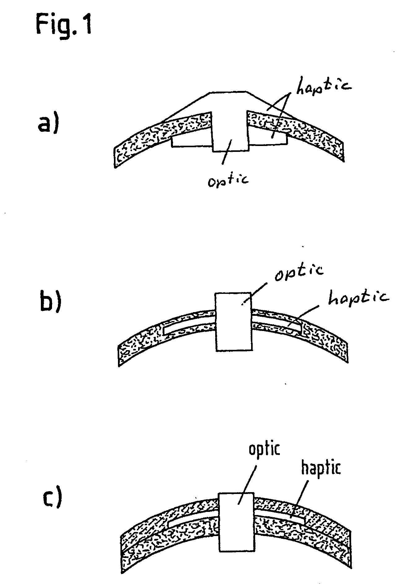 Keratoprosthesis