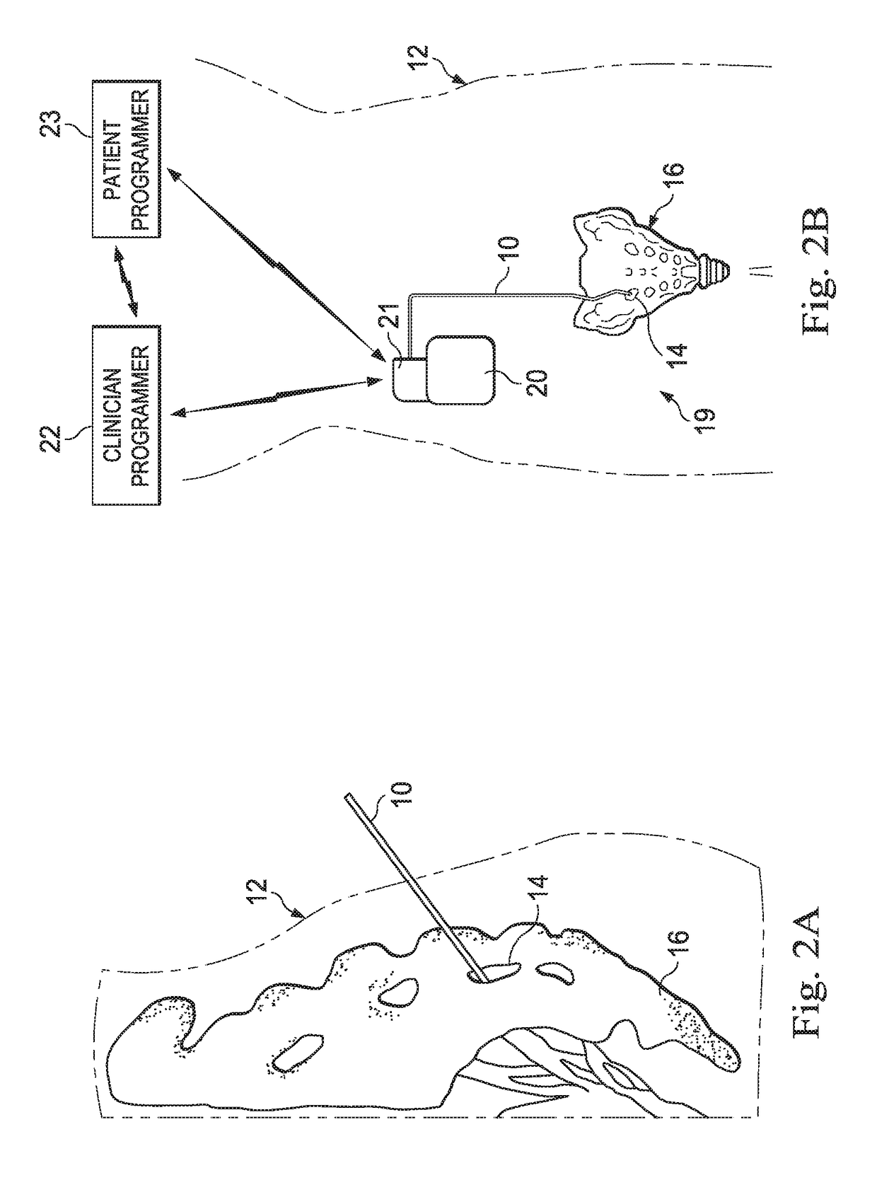 Systems, methods, and devices for evaluating lead placement based on patient physiological responses