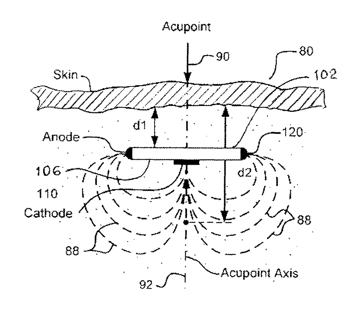 Implantable electroacupuncture device and method for treating erectile dysfunction
