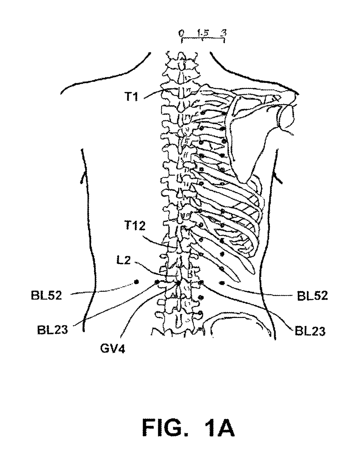 Implantable electroacupuncture device and method for treating erectile dysfunction