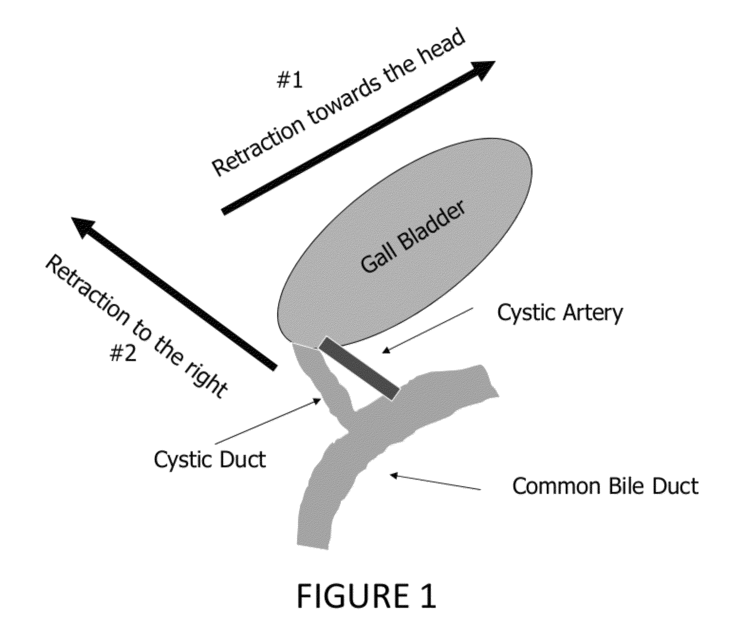 Laparoscopic retractor