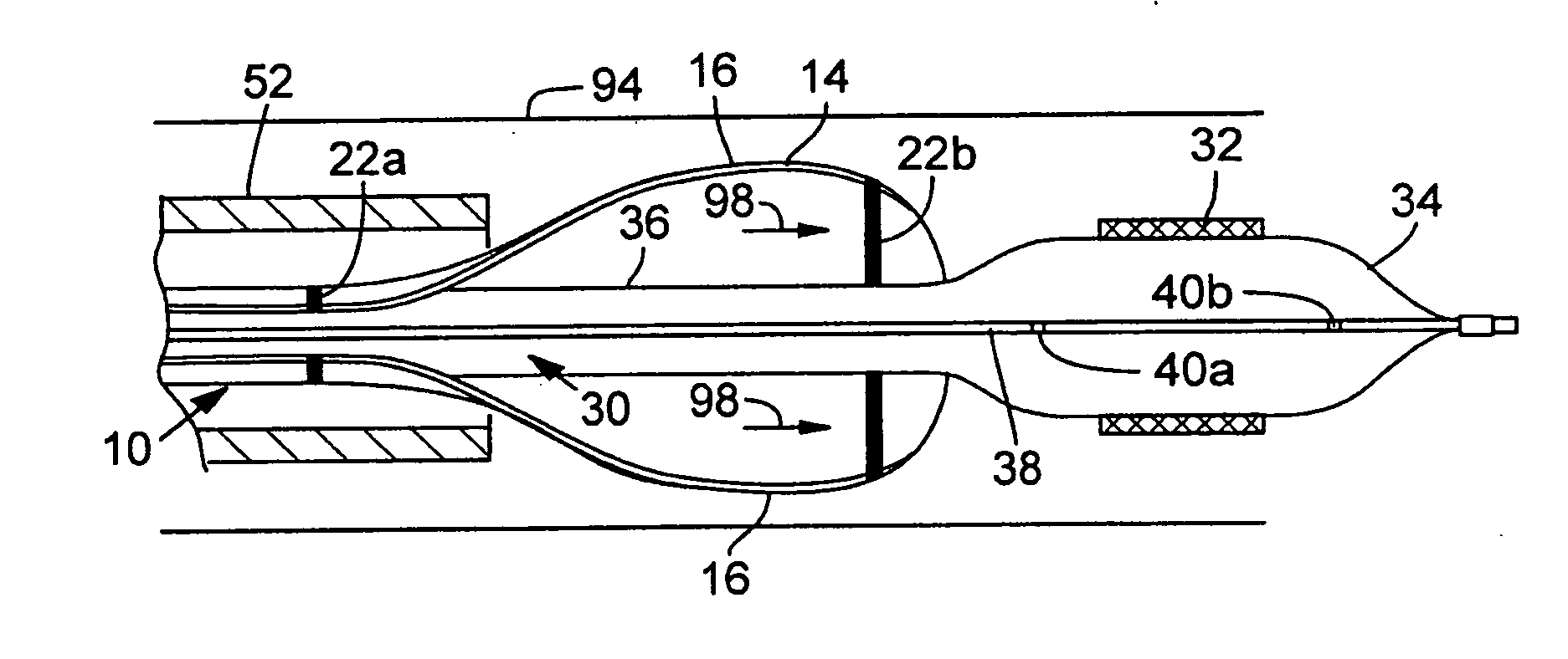 System for percutaneous delivery and removal of a prosthetic valve