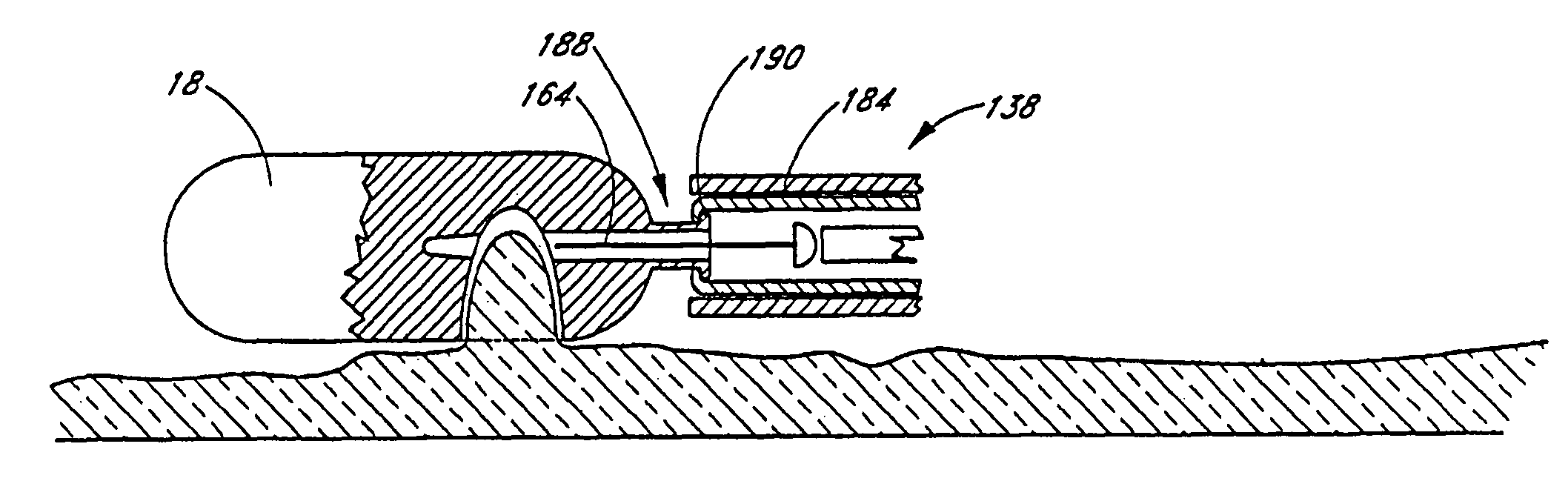 Implantable monitoring probe