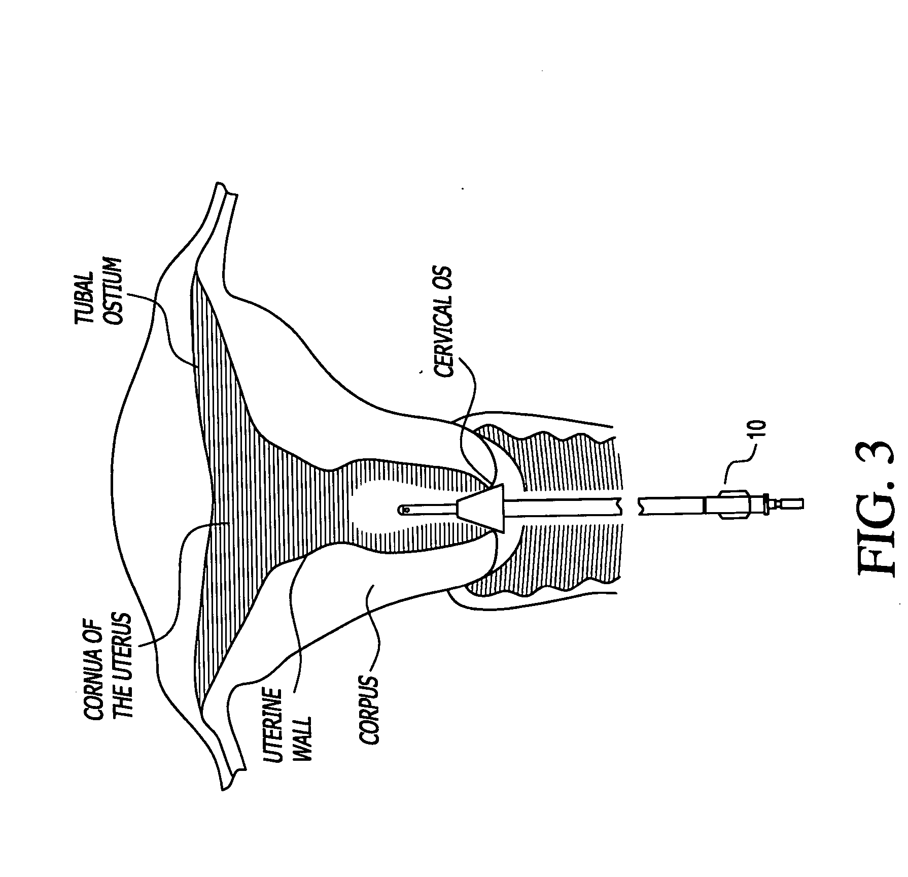 Intrauterine anesthetic applicator and cell collection device and method of use