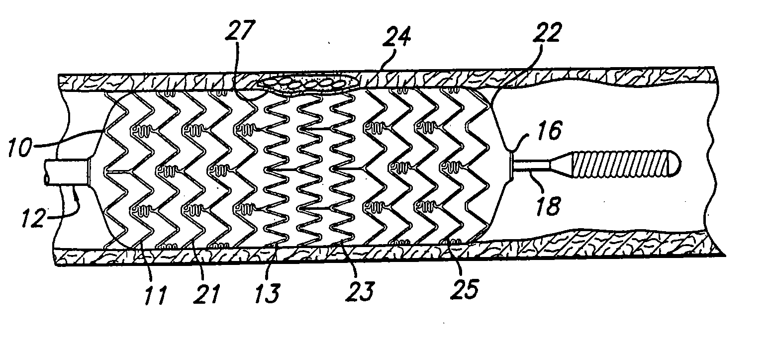 Stent for treating vulnerable plaque