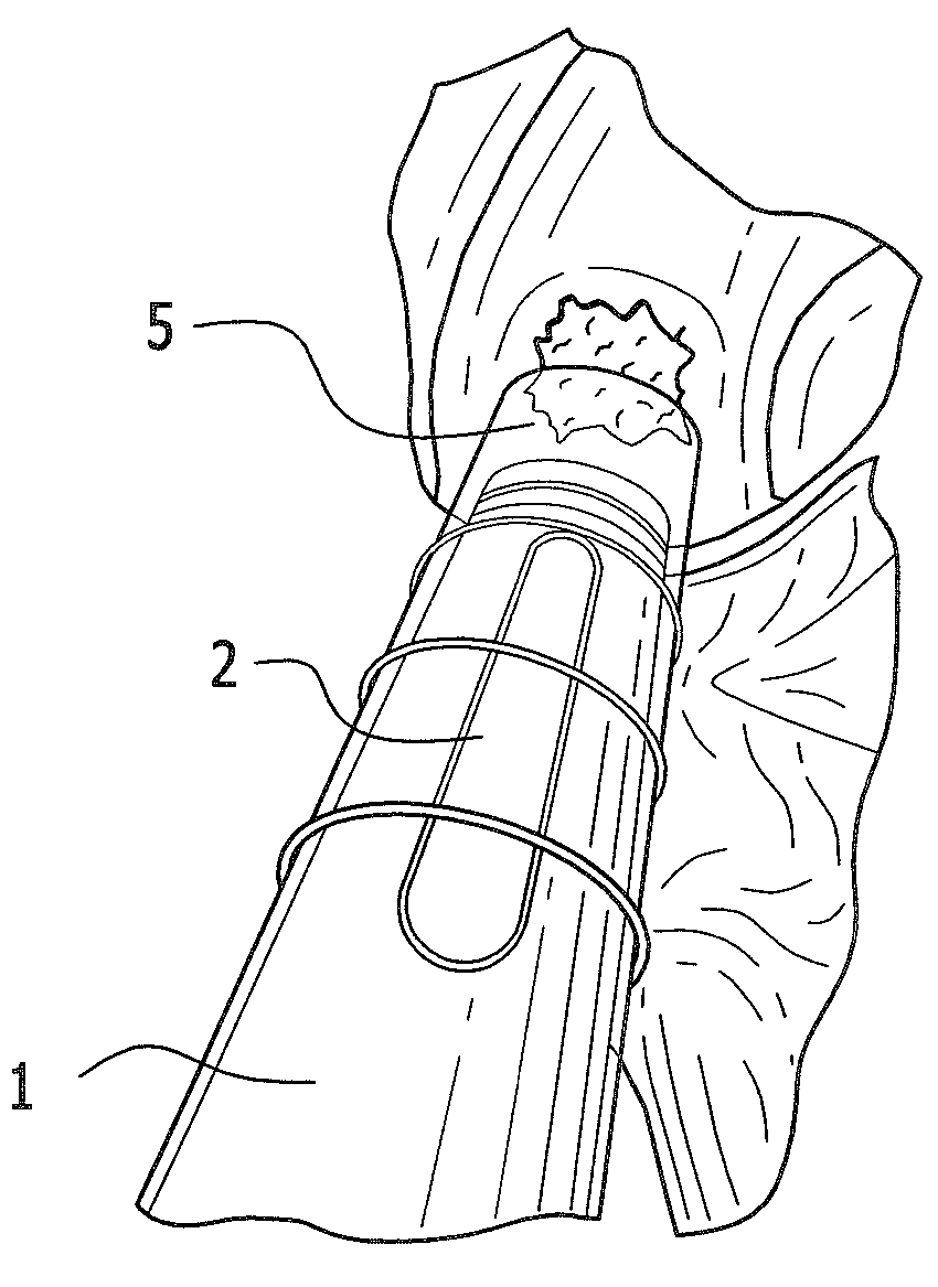 Use of a biological material containing three-dimensional scaffolds of hyaluronic acid derivatives for the preparation of implants in arthroscopy and kit for instruments for implanting said biological material by arthroscopy