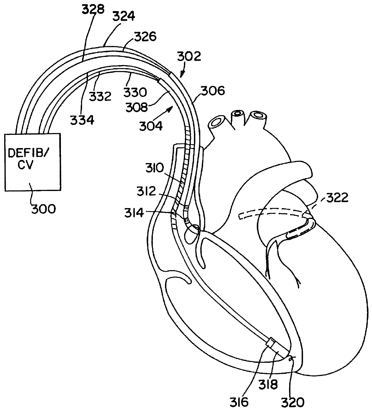 Method and apparatus for synchronization of atrial defibrillation pulses