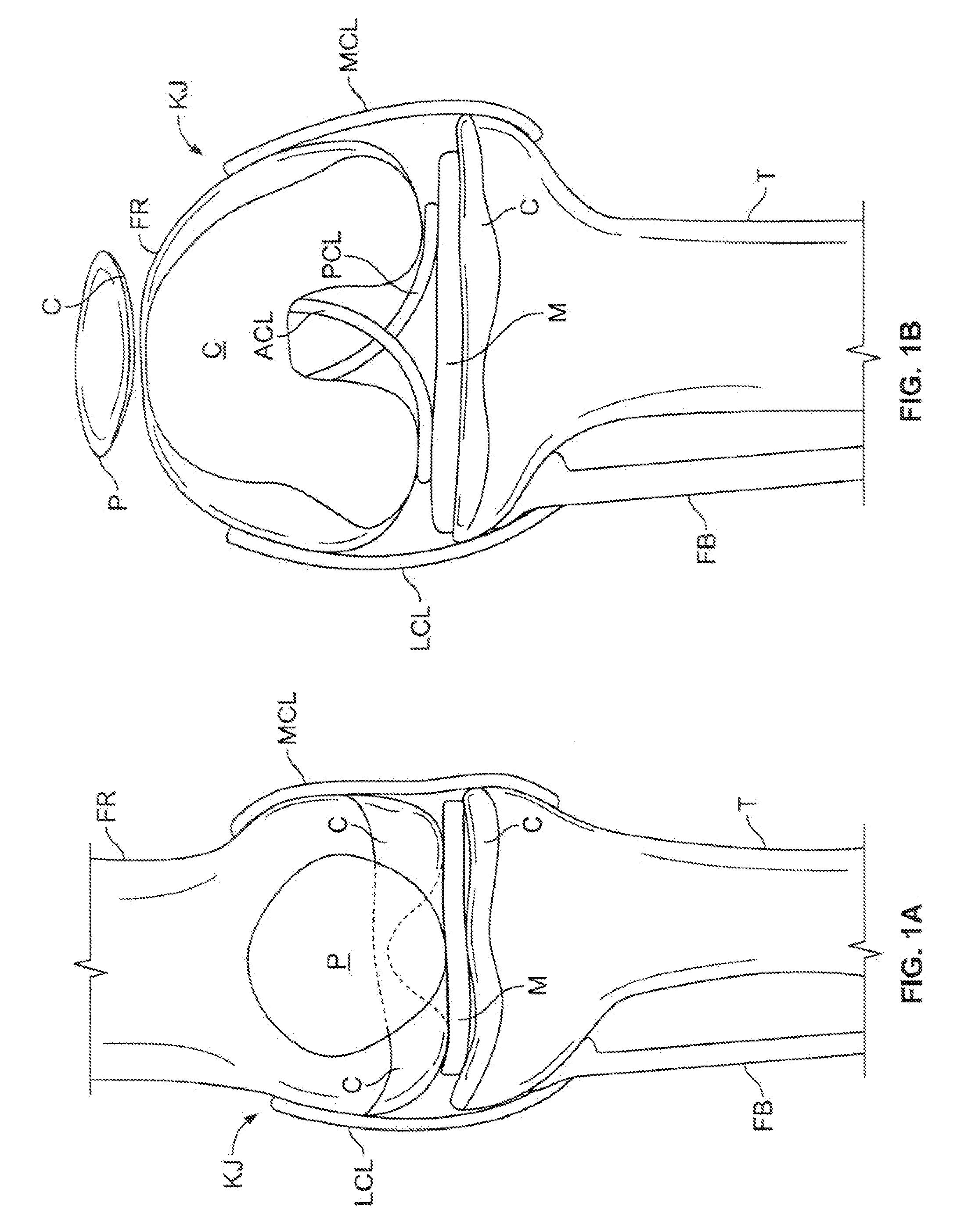 Therapeutic knee brace having pressure applicators