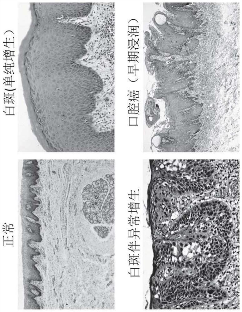 A new way to diagnose and monitor oral cancer