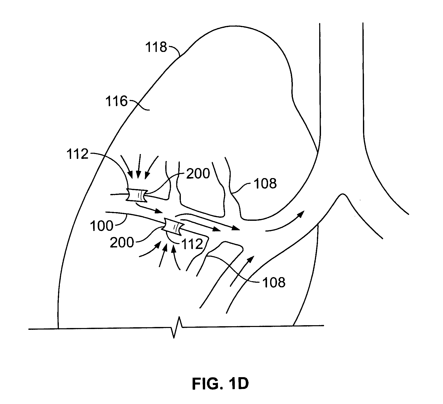 Methods and devices for maintaining surgically created channels in a body organ