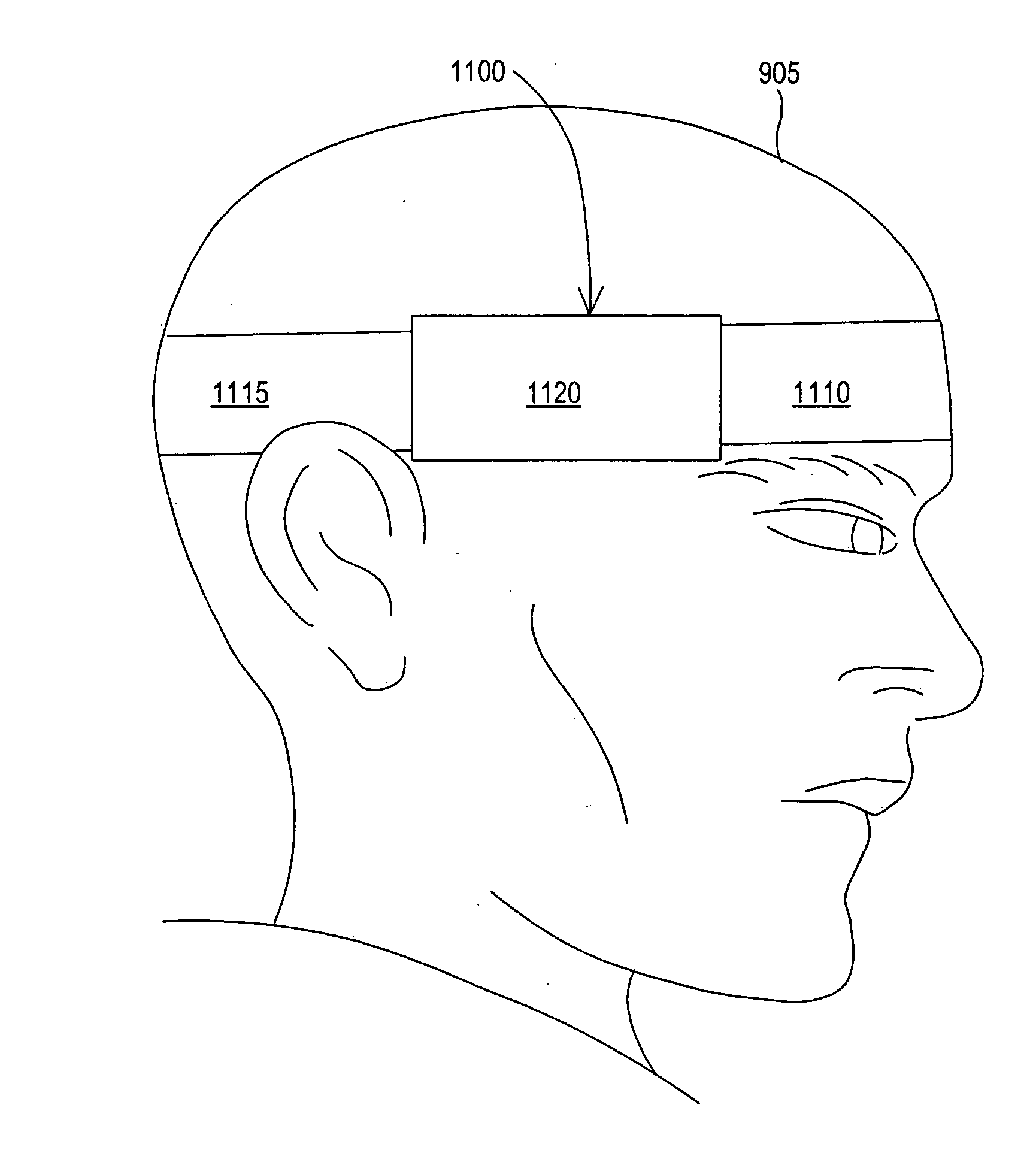 Ultrasound emitting device comprising a head frame