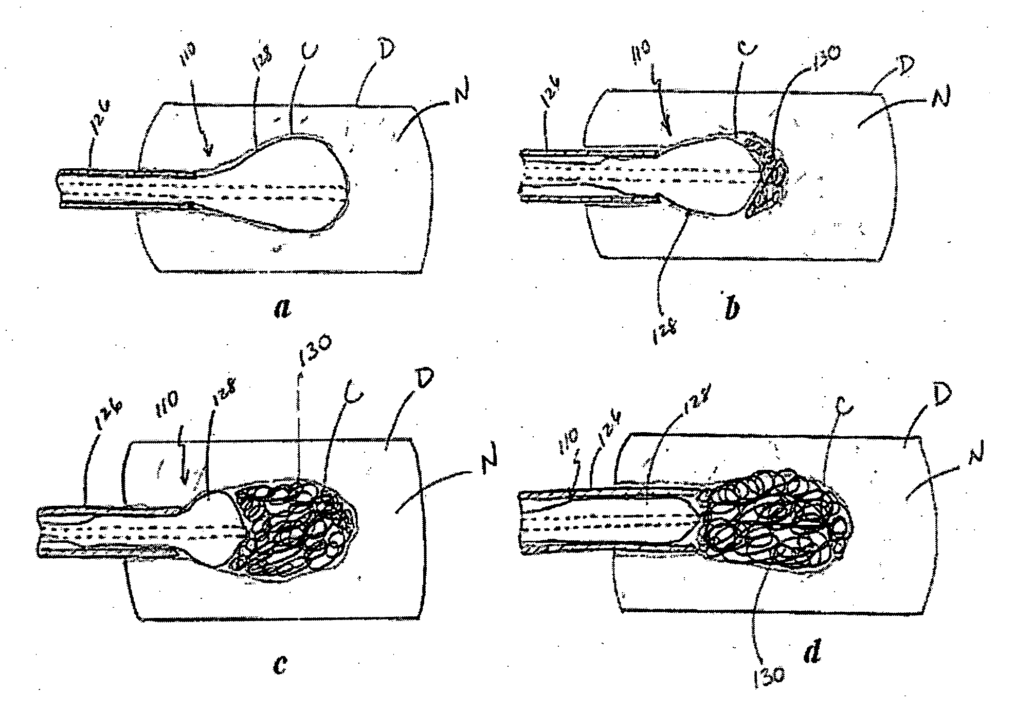 Restorative device