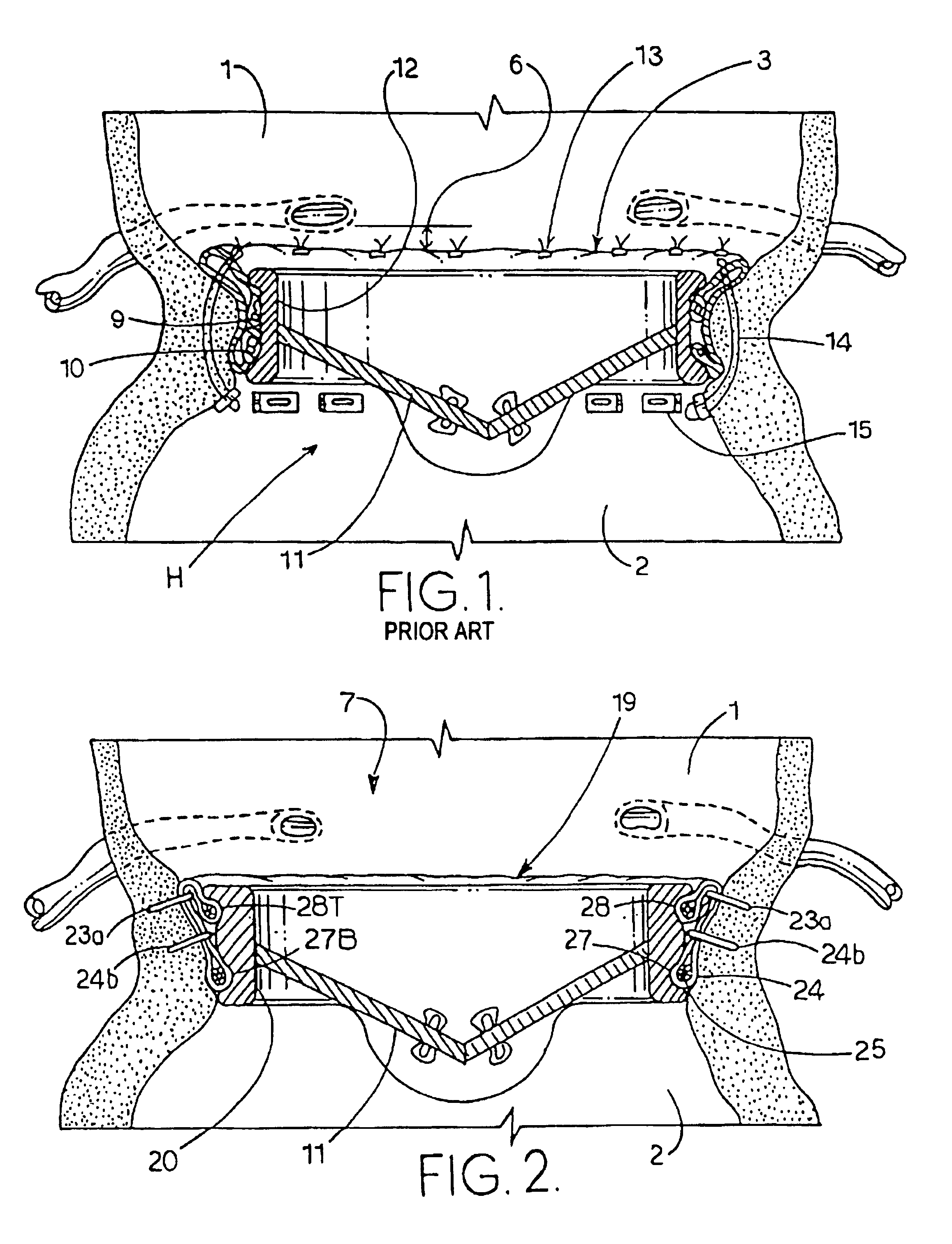 Means and method of replacing a heart valve in a minimally invasive manner
