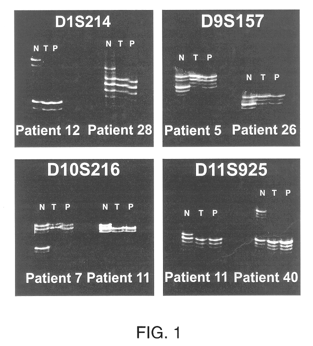 Detection of loss of heterozygosity in tumor and serum of melanoma patients