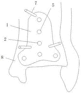 Posterior malleolus dissection and locking steel plate applicable to minimally invasive surgery