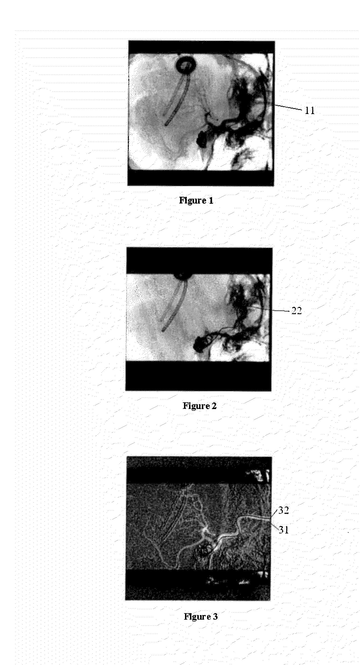 System and method for decomposed temporal filtering for x-ray guided intervention application