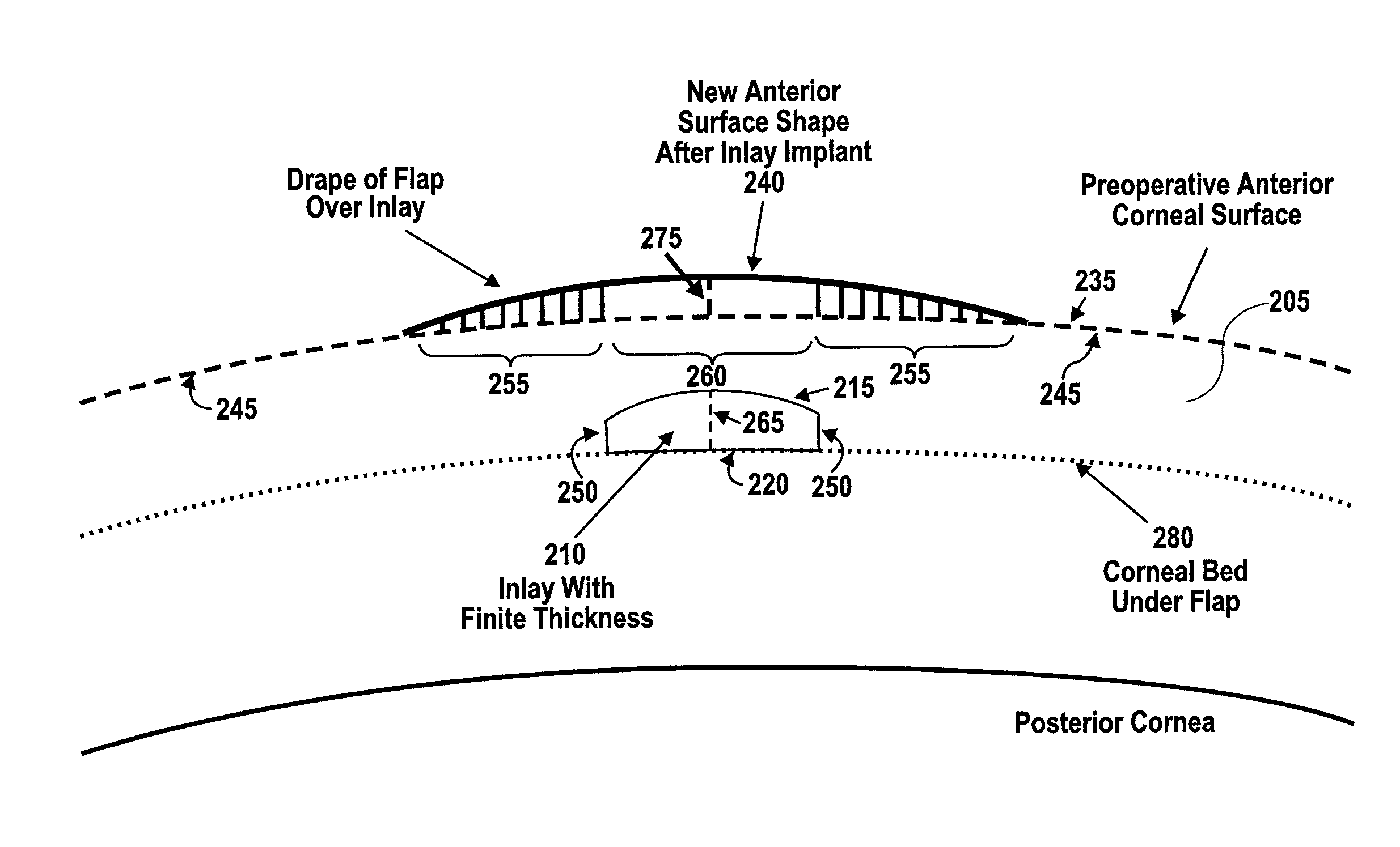 Corneal inlay design and methods of correcting vision