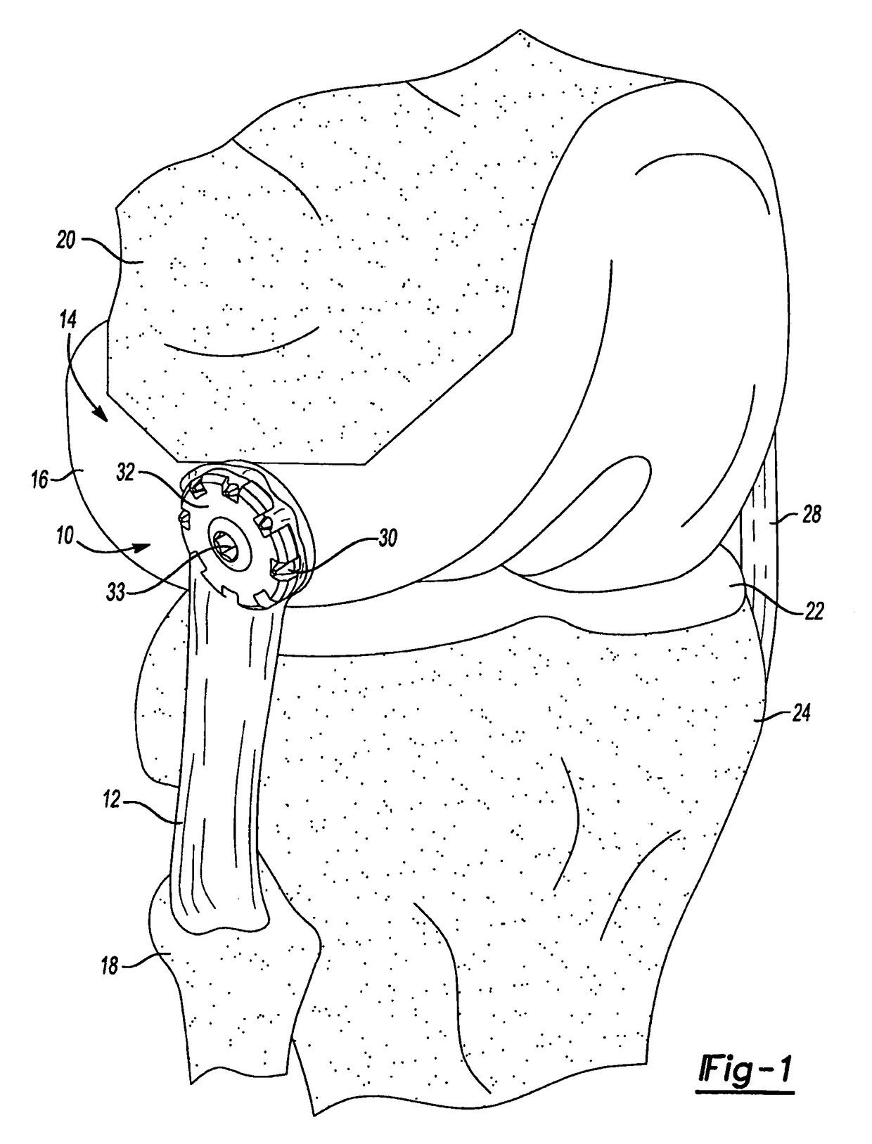 Method and apparatus for attaching soft tissue to an implant