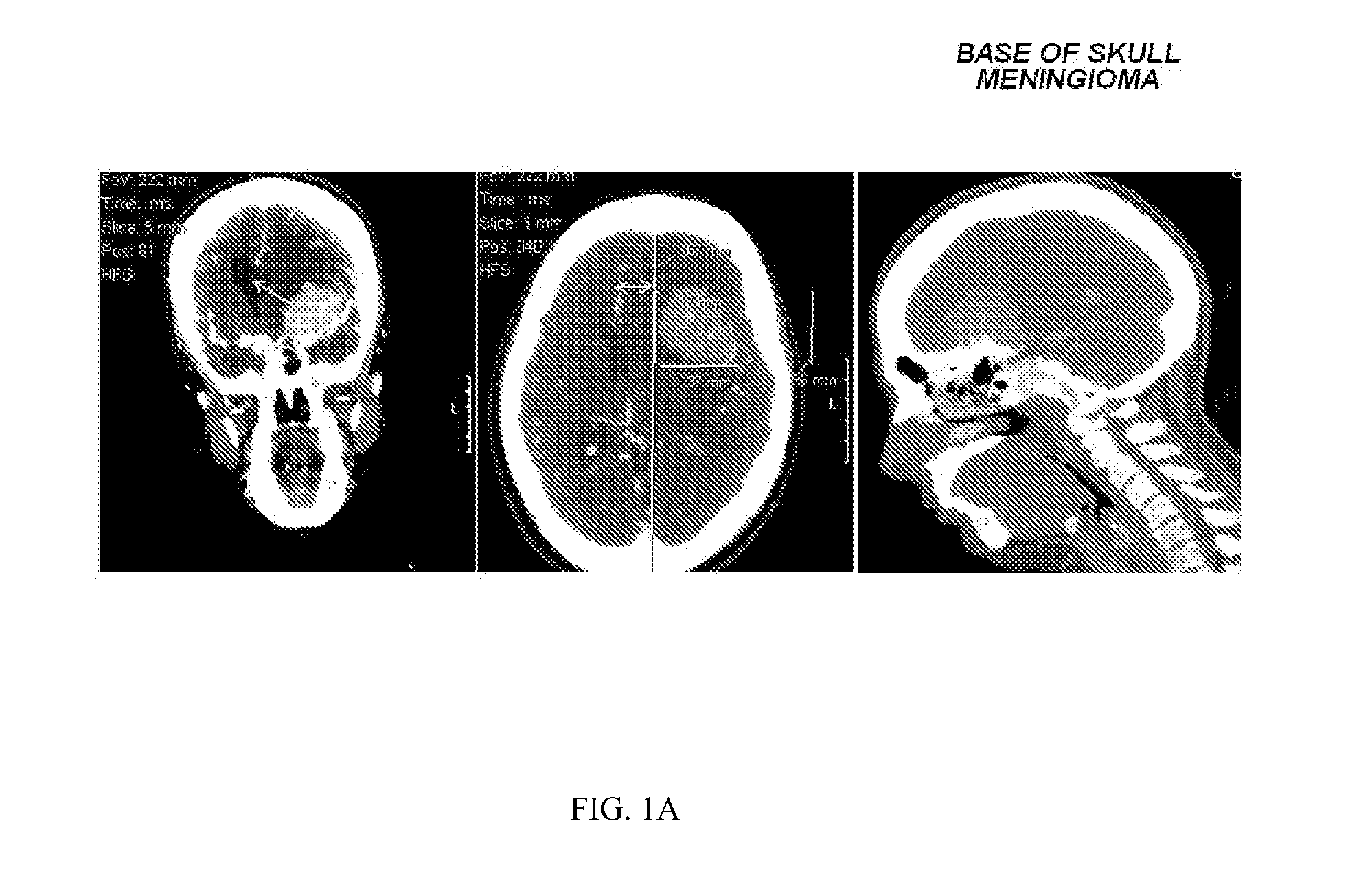 Halogenated aliphatic carboxylic acids, oligomers and/or polymers thereof and their use in devitalizing external and internal neoplasms