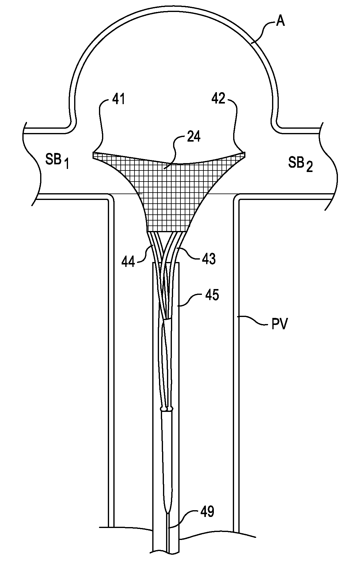 Systems and methods for supporting or occluding a physiological opening or cavity