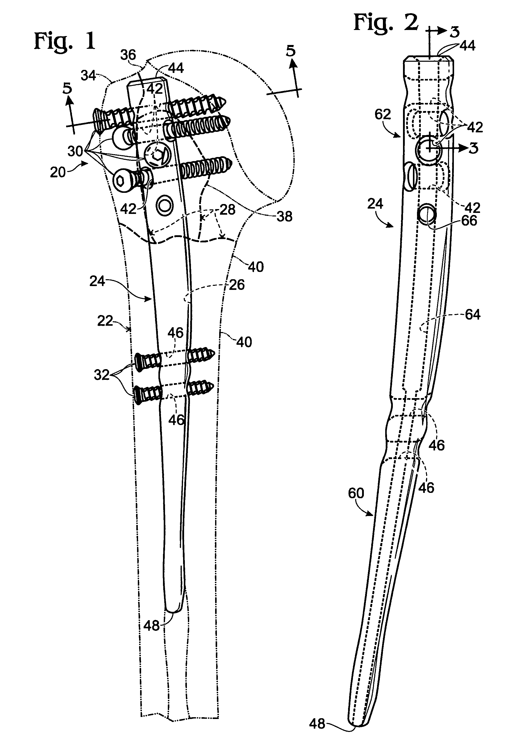 Orthopedic rod with locking aperture