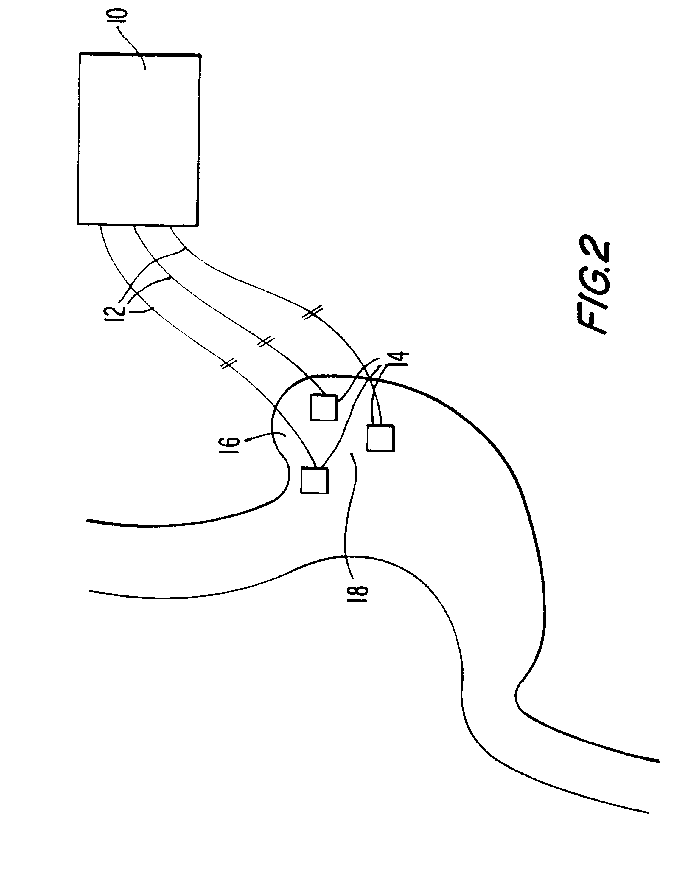 Electrical system for weight loss and laparoscopic implanation thereof