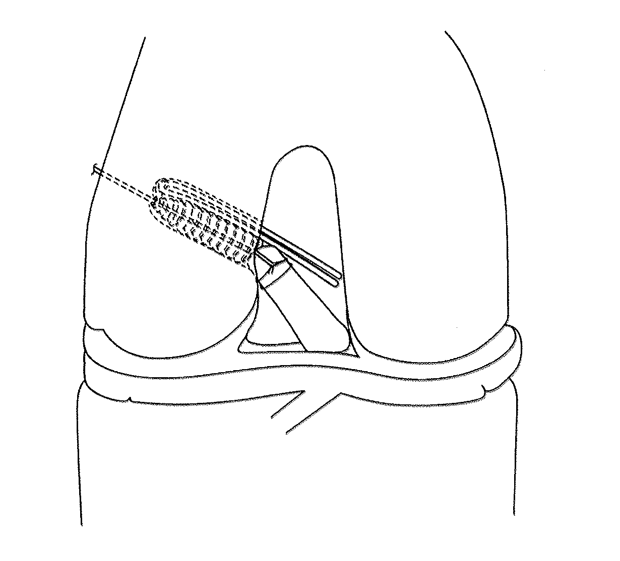 Transosteal anchoring methods for tissue repair