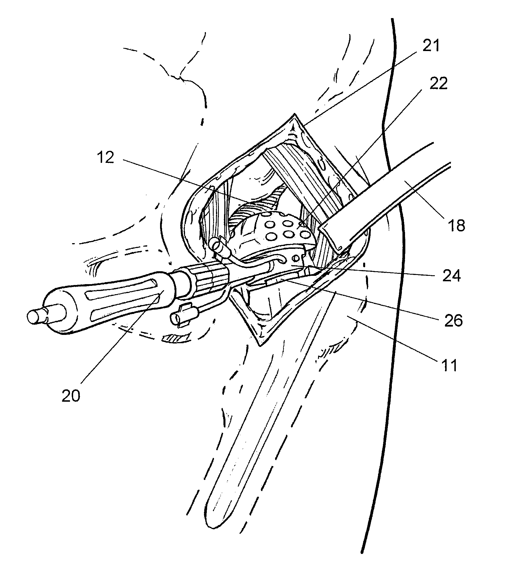Apparatus and method for minimally invasive total joint replacement