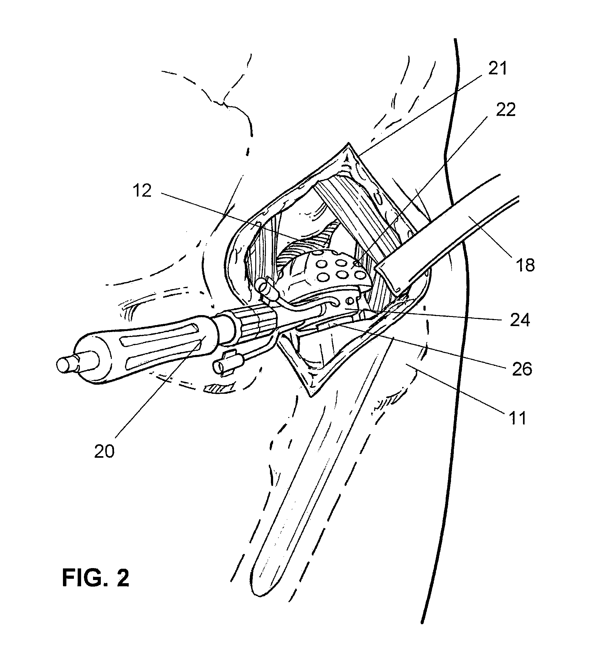 Apparatus and method for minimally invasive total joint replacement