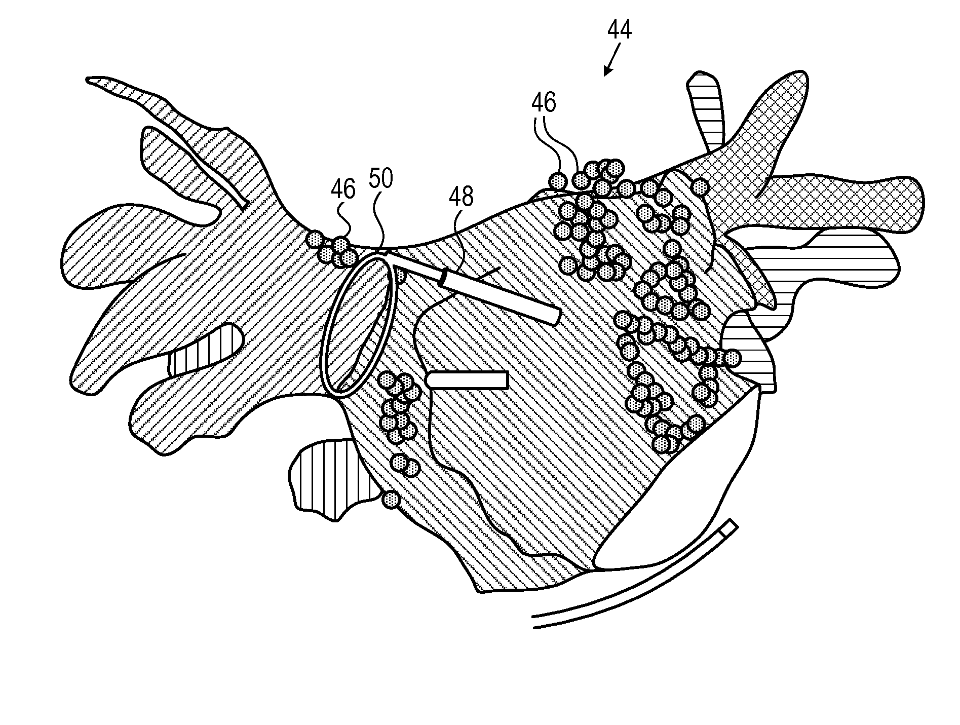 Model based reconstruction of the heart from sparse samples