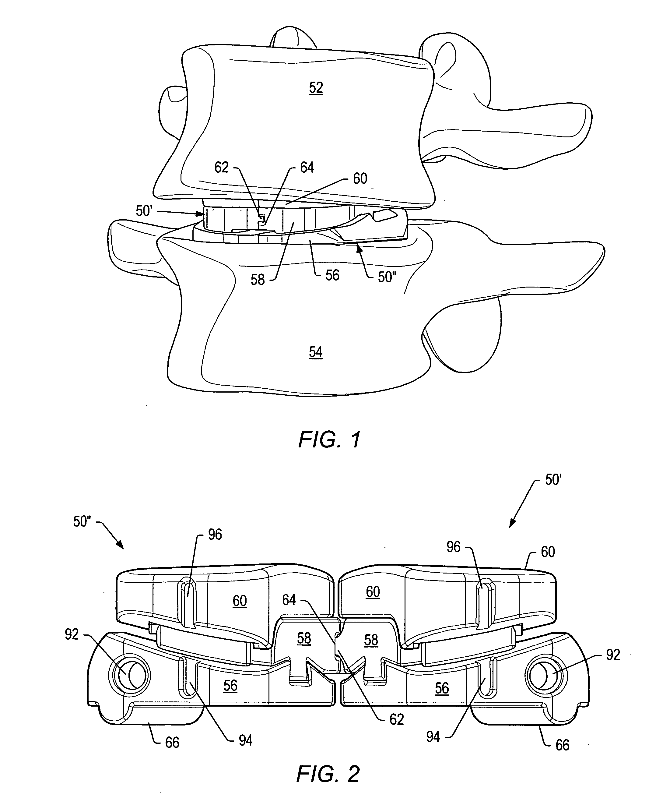 Artificial functional spinal unit system and method for use