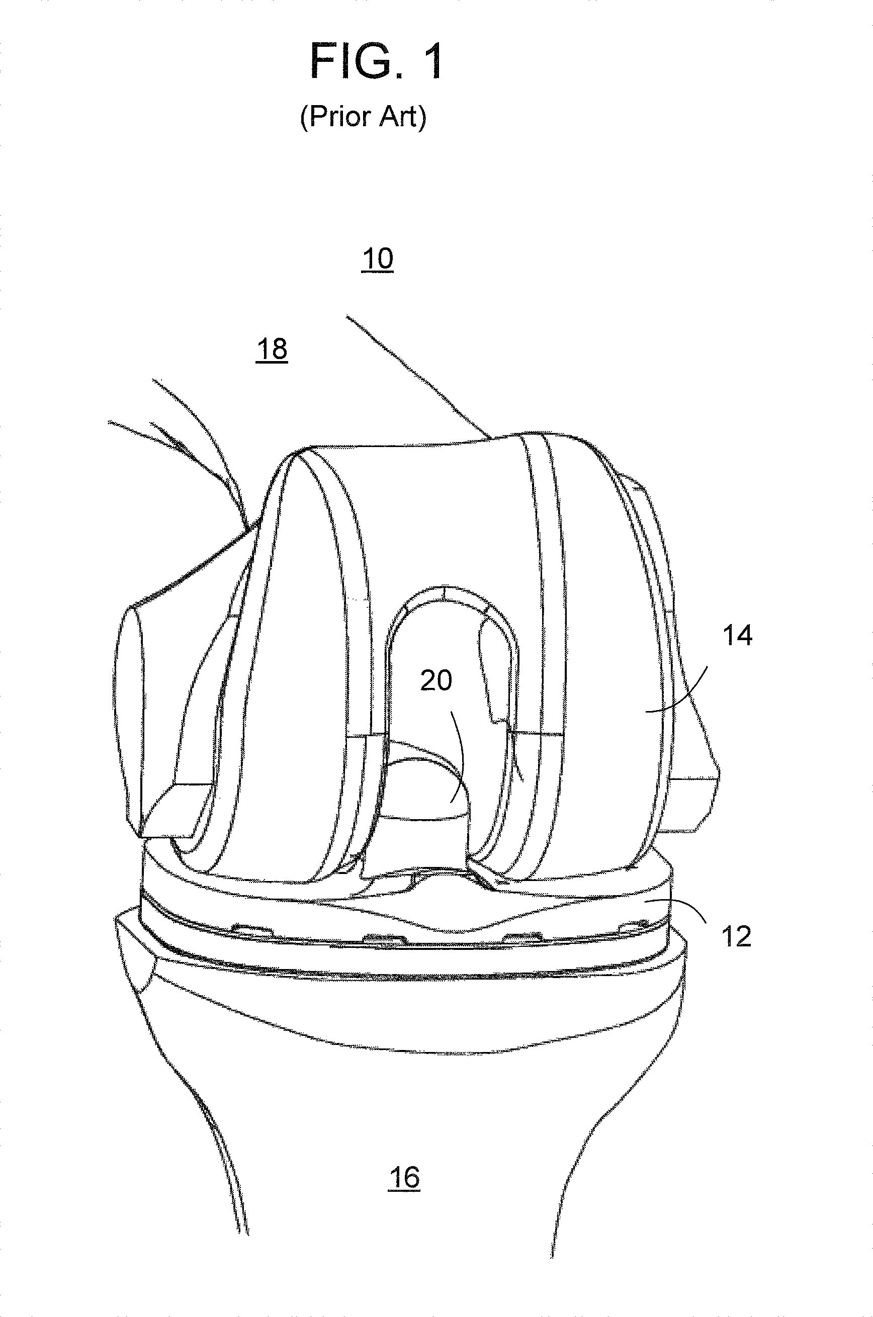 Methods and apparatus for preparing an intercondylar area of a distal femur