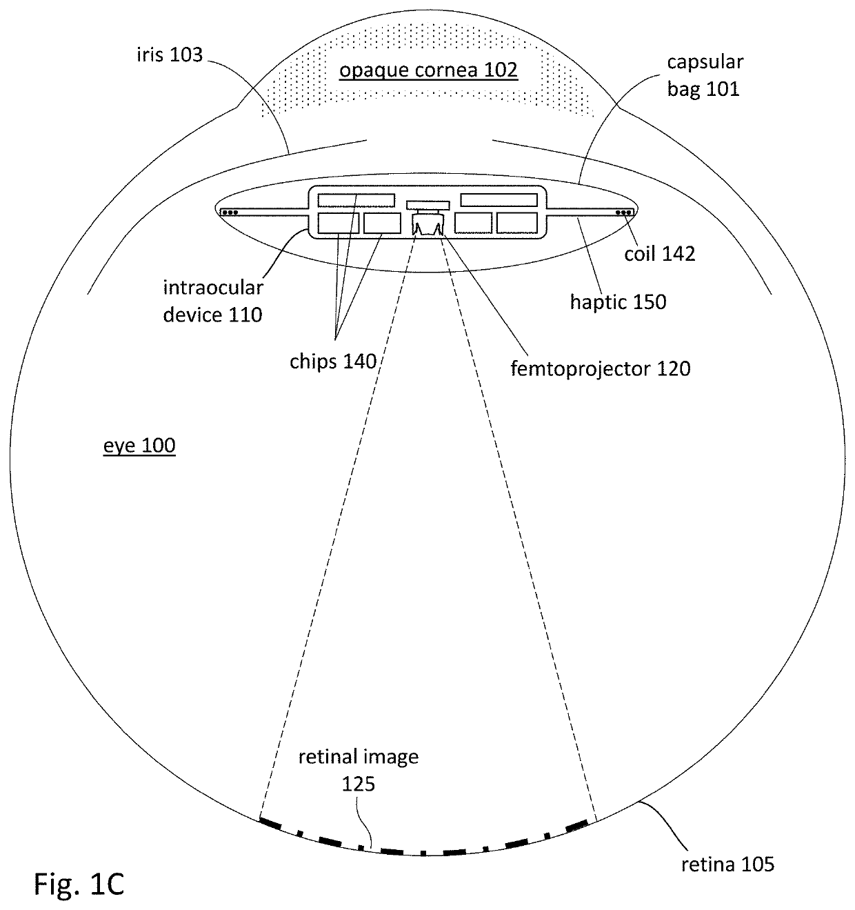 Electronic capsular tension ring