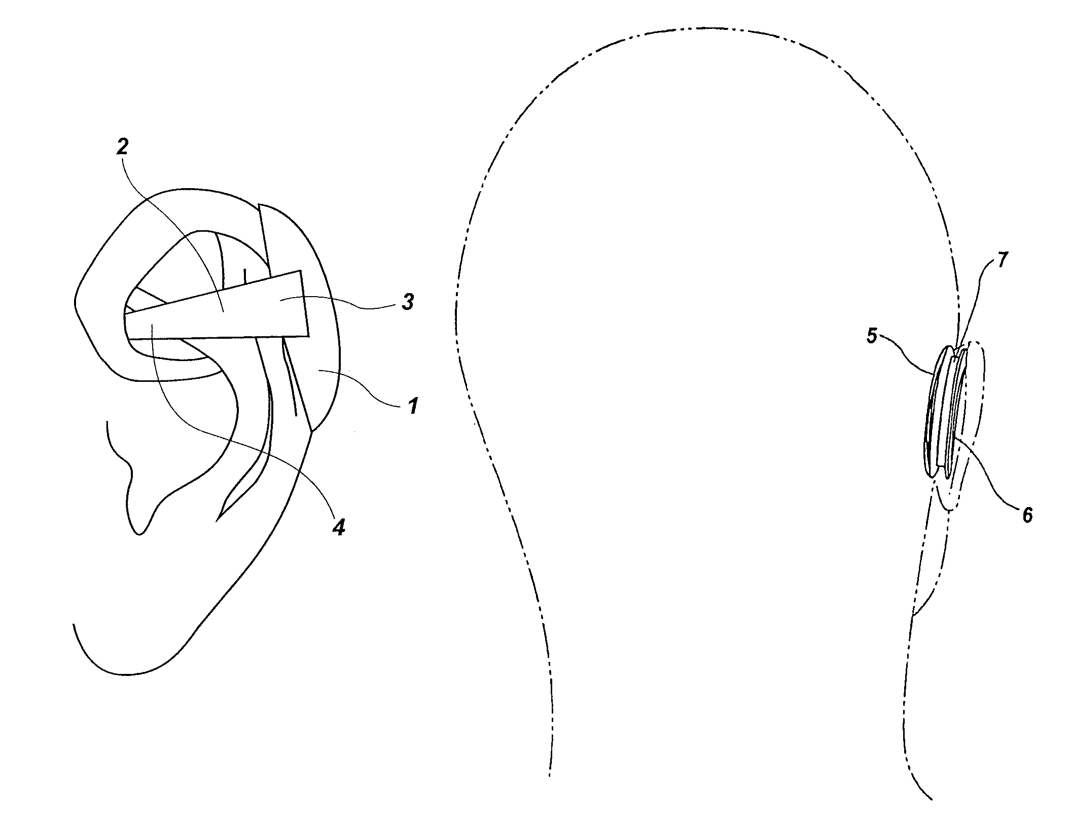 Devices and methods for reshaping cartilage structures