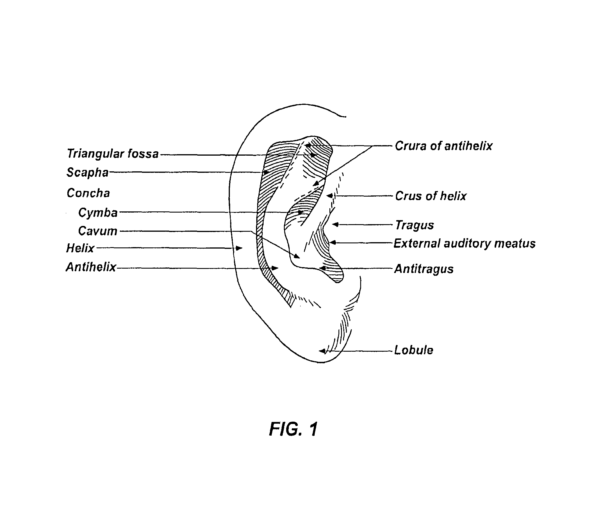 Devices and methods for reshaping cartilage structures