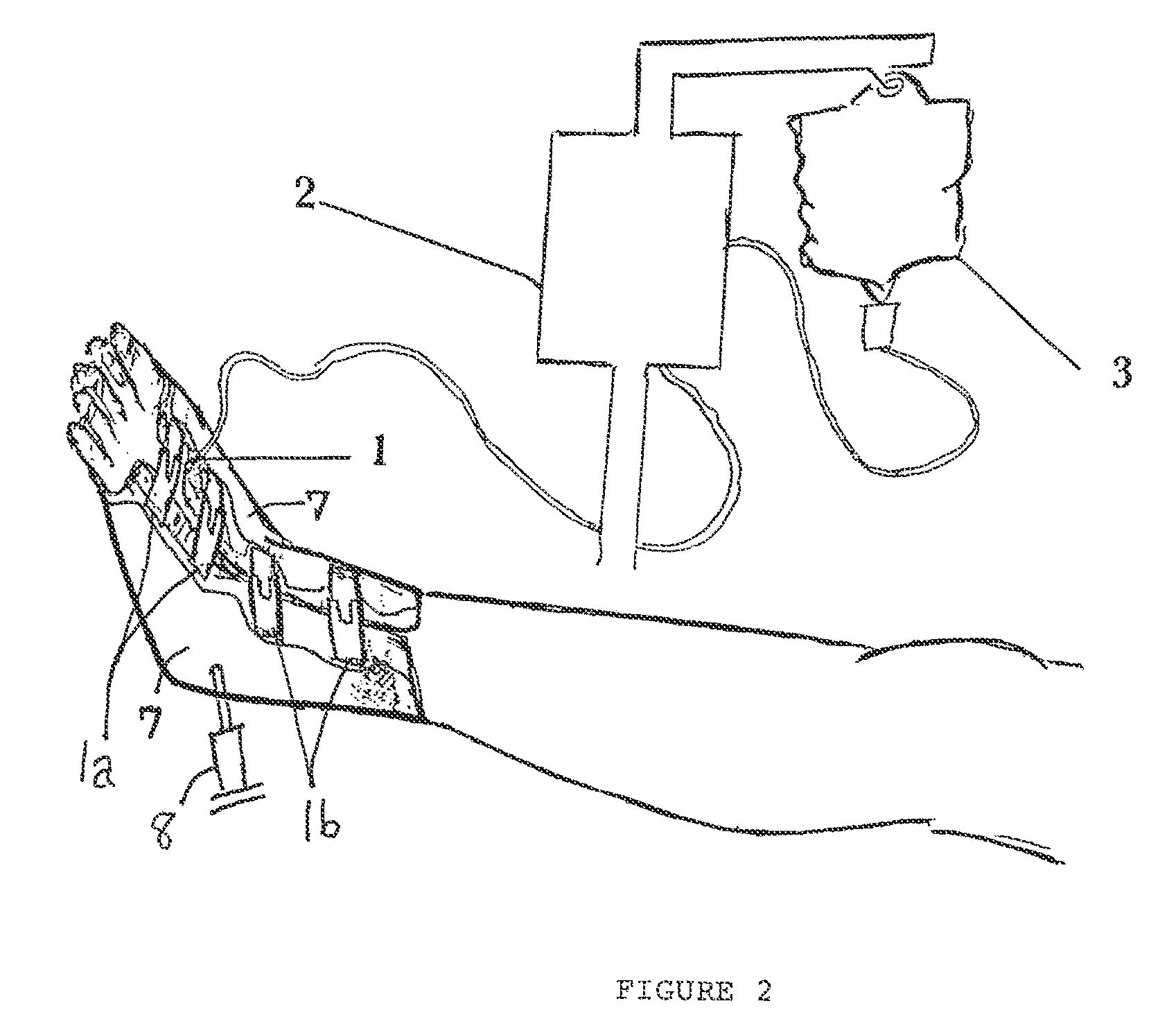 Device and method for prevention and treatment of deep venous thrombosis