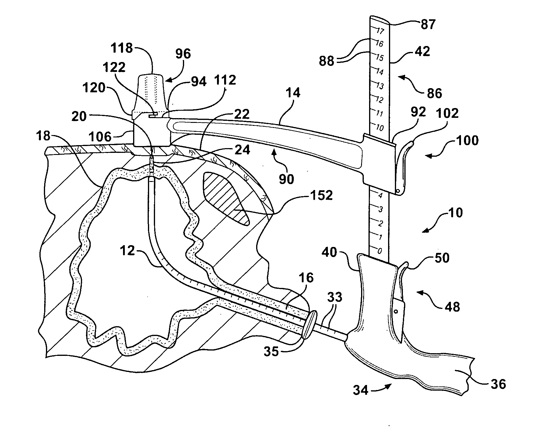 Method of Performing a Suprapubic Transurethral Cystostomy and Associated Procedures and Apparatus Therefor