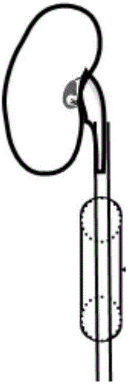 A Combination Tool for Establishing a Porcine Model of Recanalization of Unilateral Ureteral Obstruction