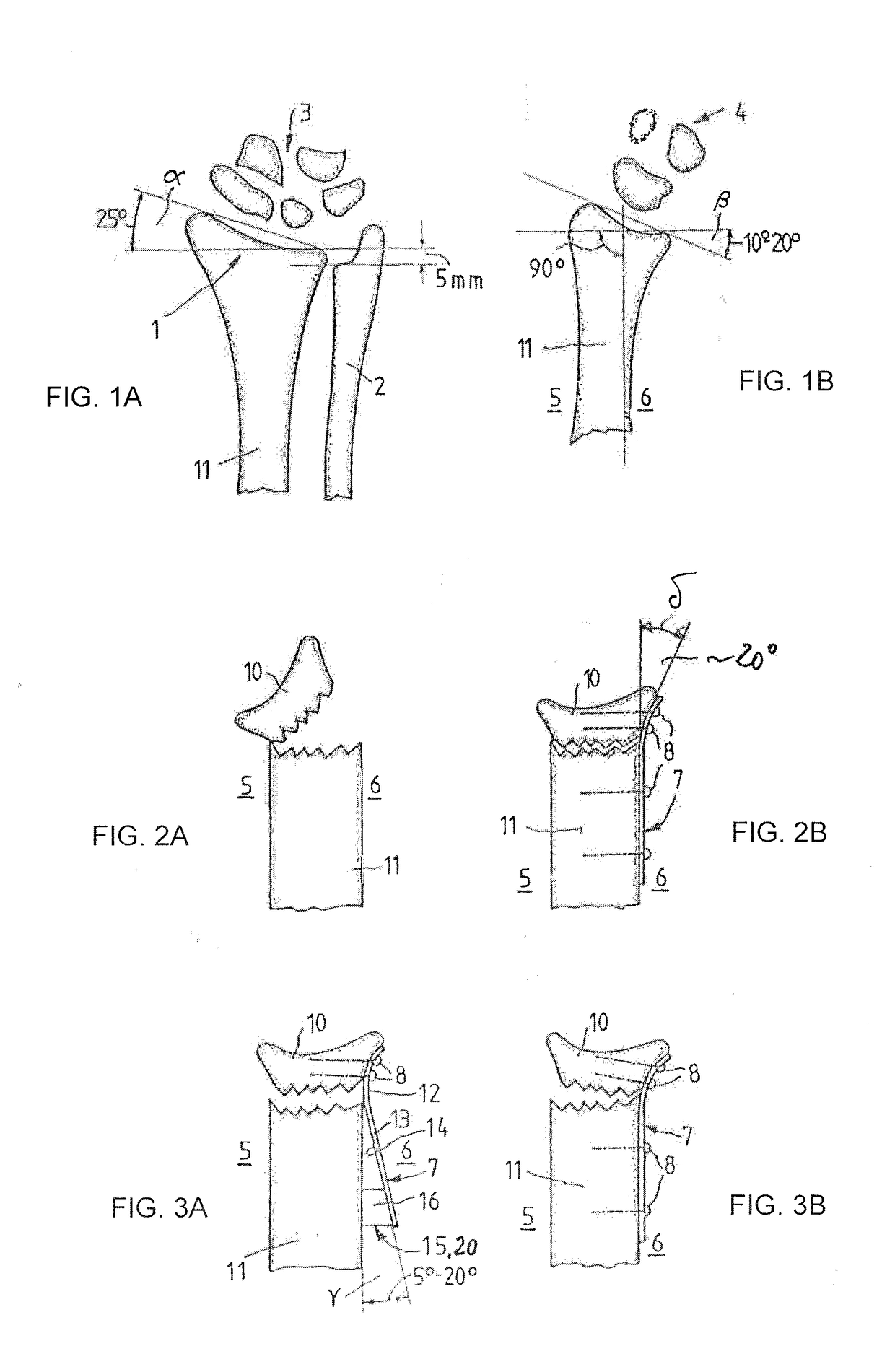 Method of treating a distal radius fracture